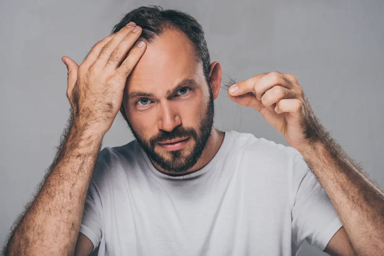 Alopecia Femenina